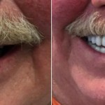 Smile Gallery: Before and after treatment