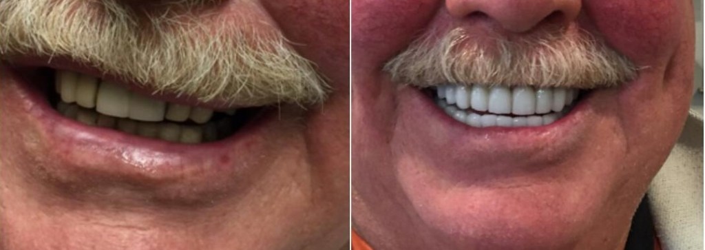 Smile Gallery: Before and after treatment
