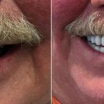 Smile Gallery: Before and after treatment