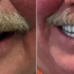 Smile Gallery: Before and after treatment