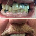 Smile Gallery: Before with crooked, discolored teeth and after, with even white teeth