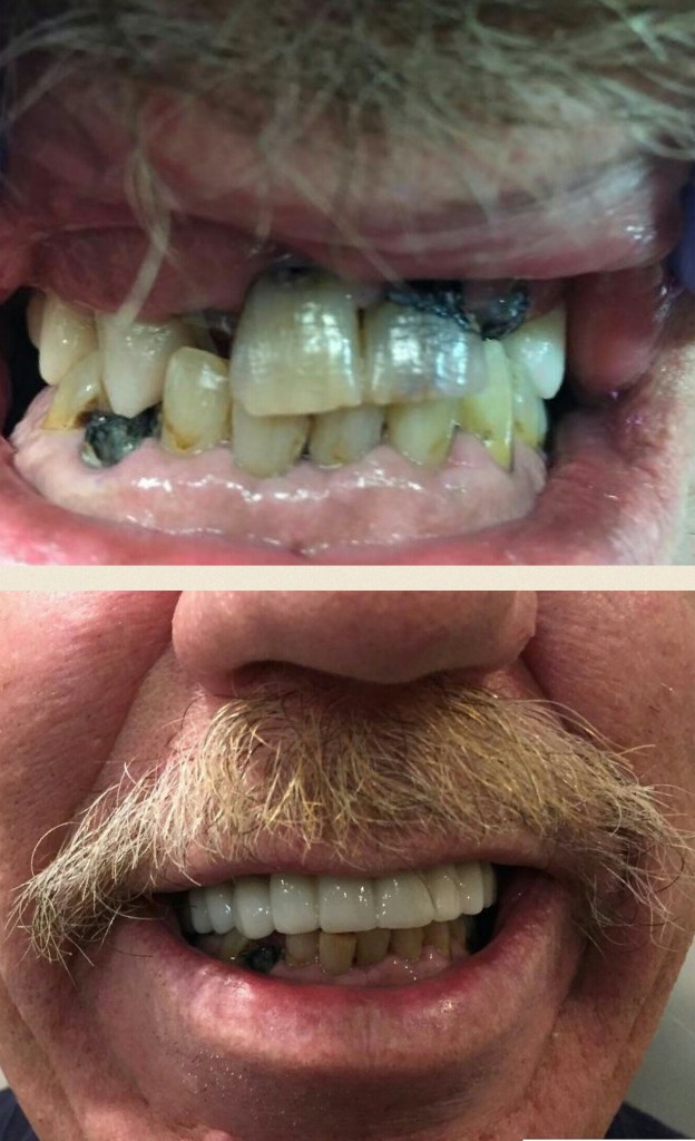 Smile Gallery: Before with crooked, discolored teeth and after, with even white teeth