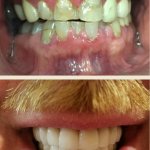 Smile Gallery: Before with small, discolored teeth and after, with even white teeth
