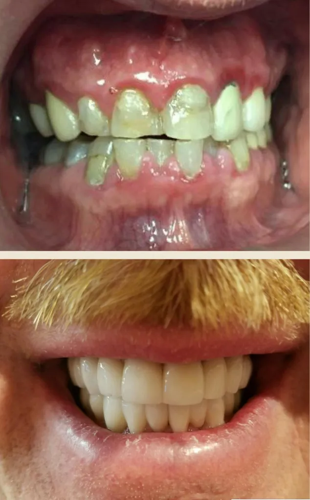 Smile Gallery: Before with small, discolored teeth and after, with even white teeth