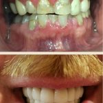 Smile Gallery: Before with small, discolored teeth and after, with even white teeth