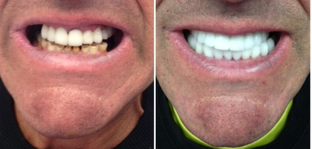 Smile Gallery: Before and after