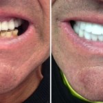 Smile Gallery: Before and after