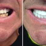 Smile Gallery: Before and after
